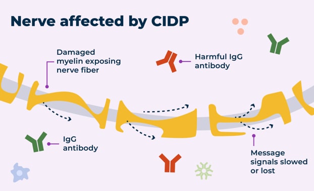 For some people with CIDP, harmful IgG antibodies that remain in the body too long can cause damage to the protective later around the nerve called myelin.